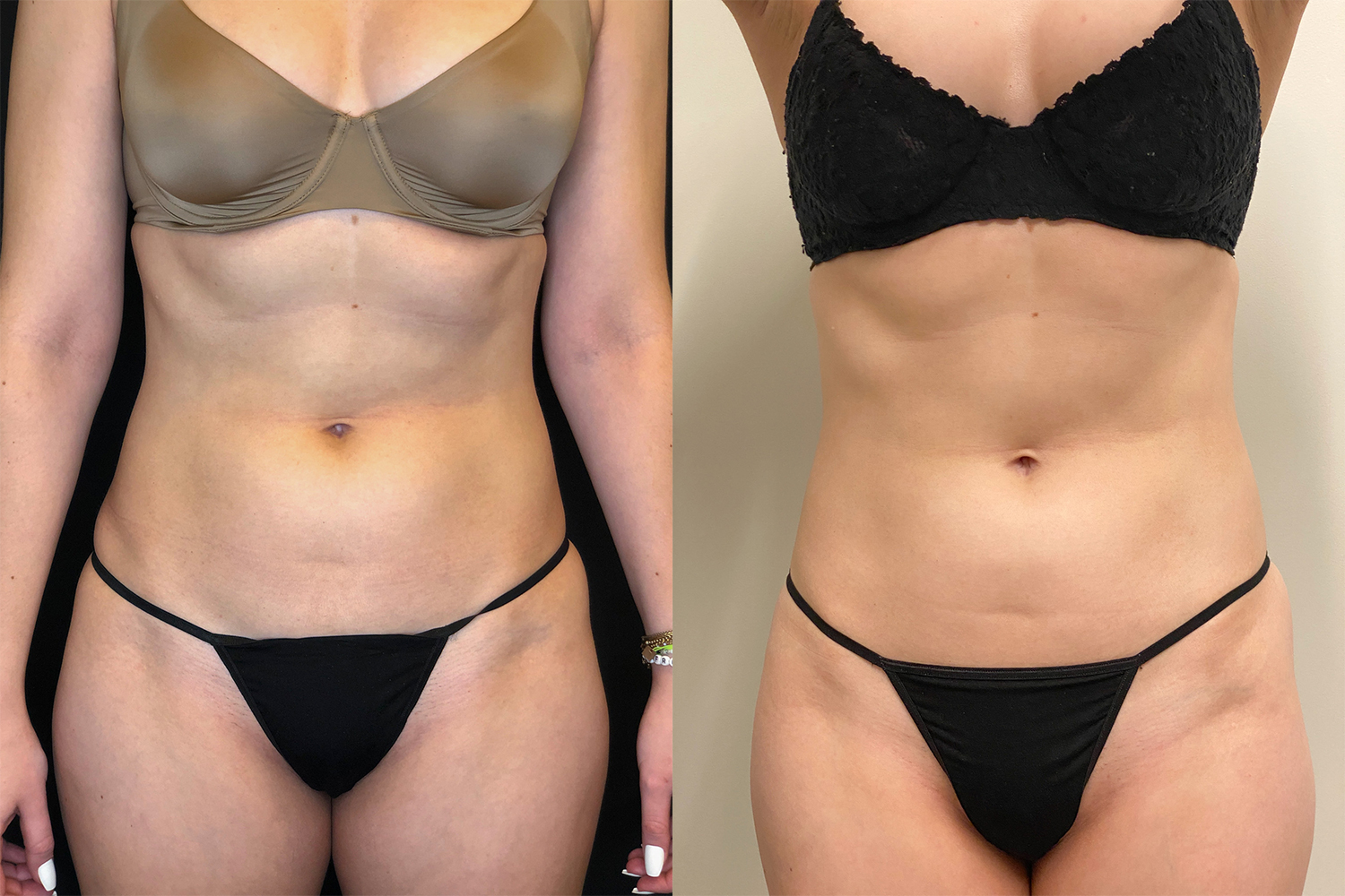 EMTSculpt före och efter mage hos Hudsalong Anna Maria Huskvarna
